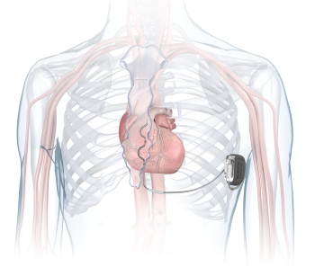 McLaren Flint Among First in the US to Implant First-of-its-Kind Heart Device